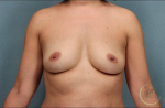 Breast Augmentation Case 2 Before